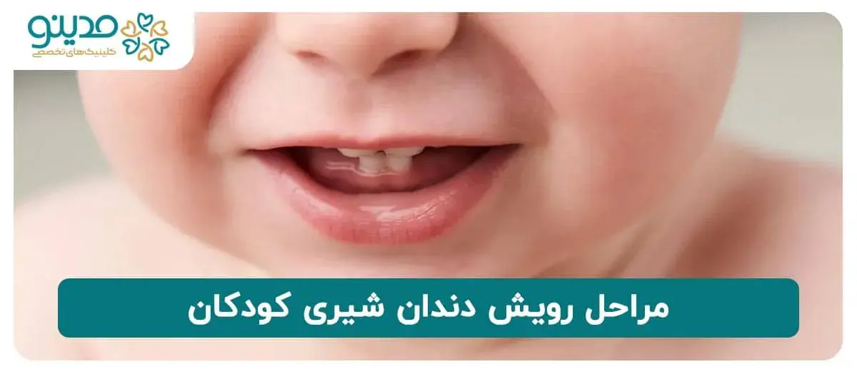 مراحل رویش دندان شیری کودکان
