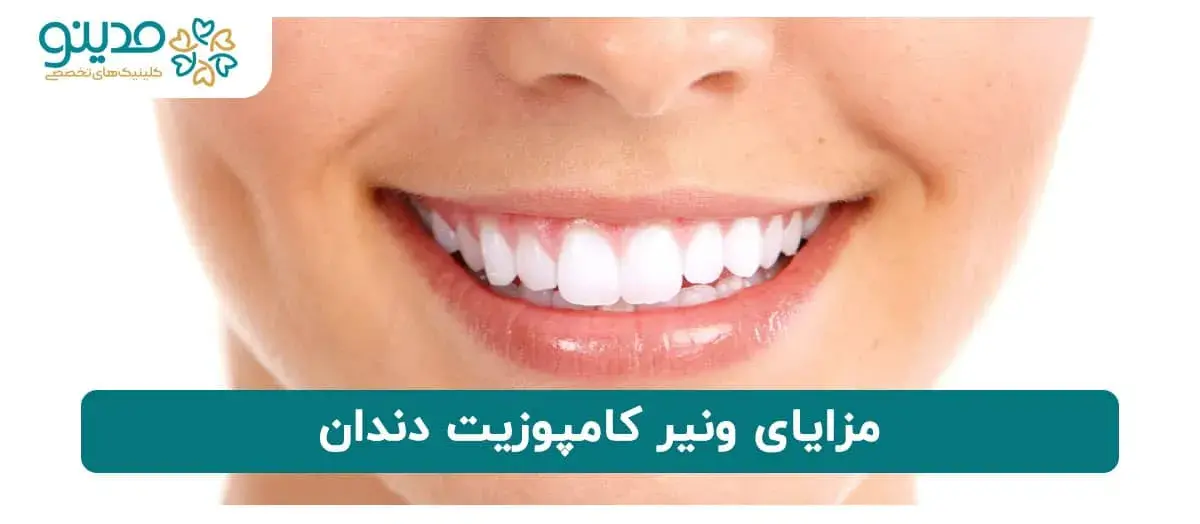مزایای ونیر کامپوزیت دندان