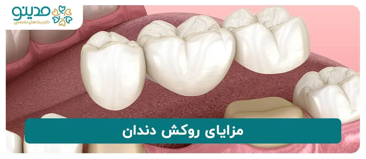 مزایای روکش دندان