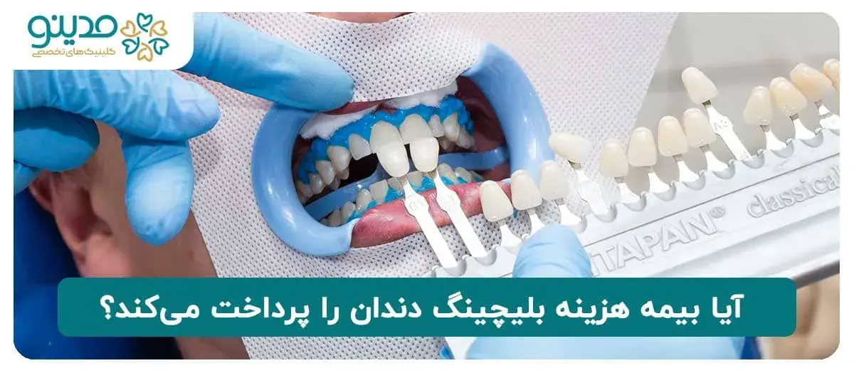 آیا بیمه هزینه بلیچینگ دندان را پرداخت می‌کند؟