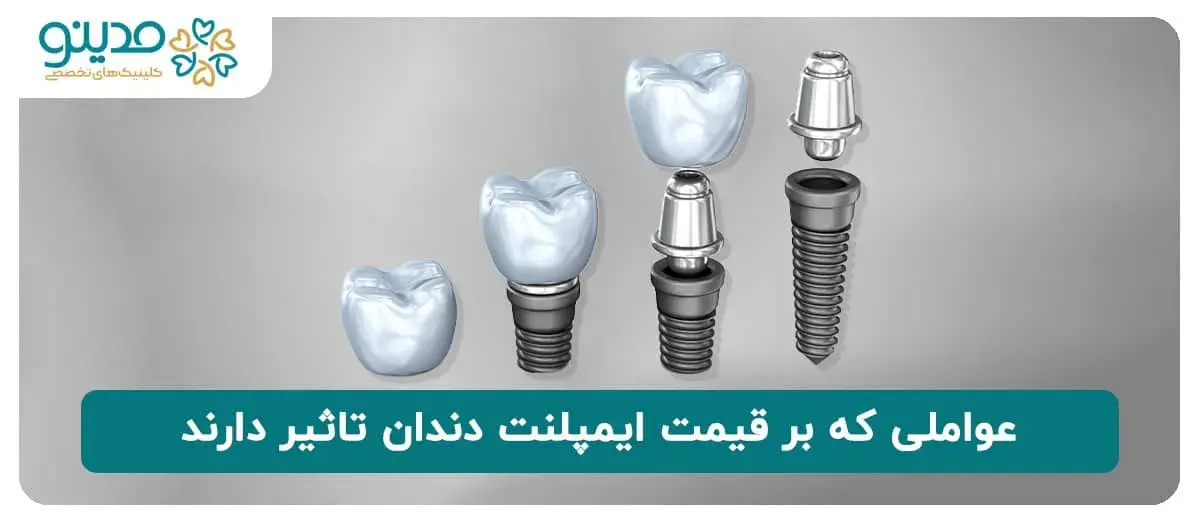 عوامل تاثیرگذار بر قیمت ایمپلنت دندان