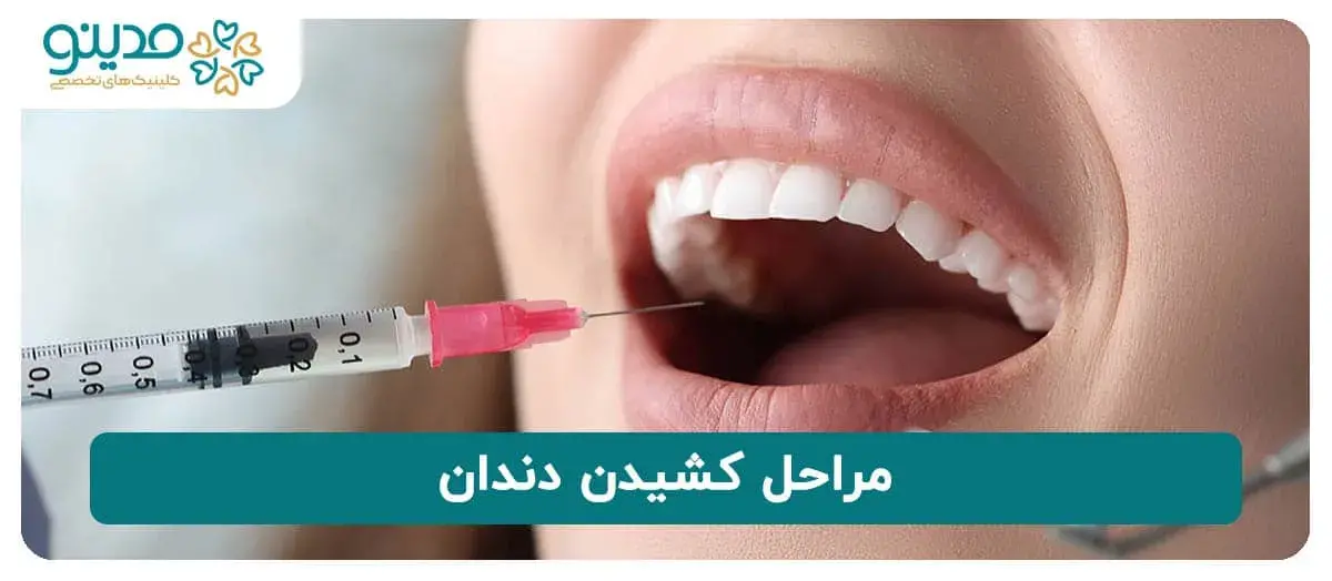 انواع مراحل کشیدن دندان