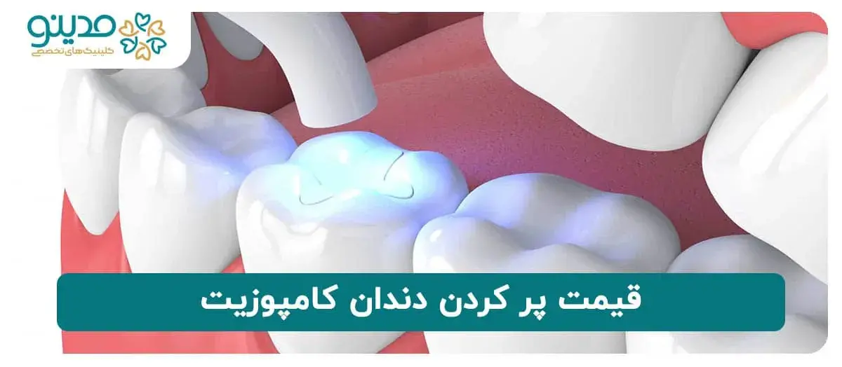 قیمت پر کردن دندان با کامپوزیت