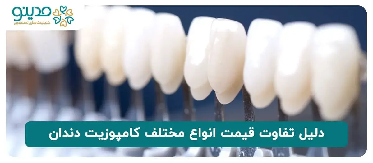 دلیل تفاوت قیمت انواع مختلف کامپوزیت دندان