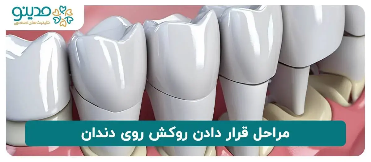 مراحل قرار دادن روکش روی دندان