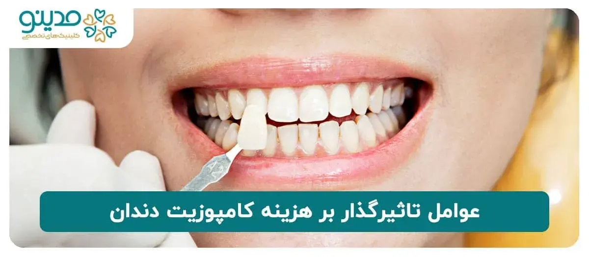 عوامل تاثیرگذار بر هزینه کامپوزیت دندان 