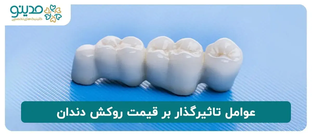 عوامل تاثیرگذار بر قیمت روکش دندان 