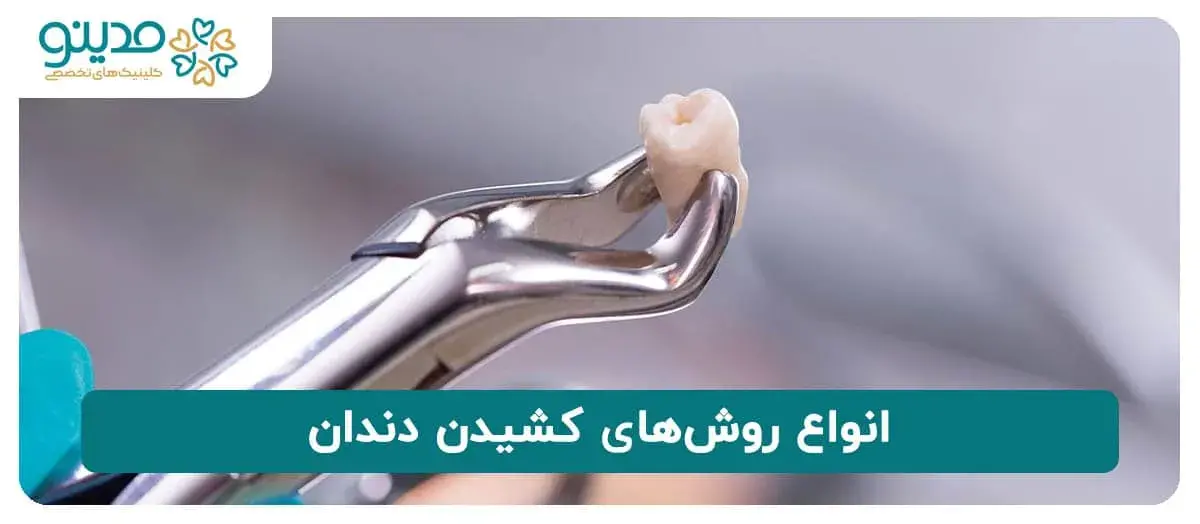 انواع روش‌های کشیدن دندان