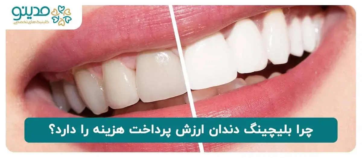 چرا بلیچینگ دندان ارزش پرداخت هزینه را دارد؟