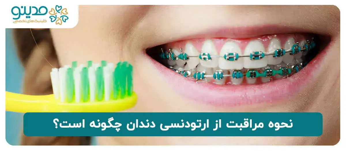 نحوه مراقبت از ارتودنسی دندان 