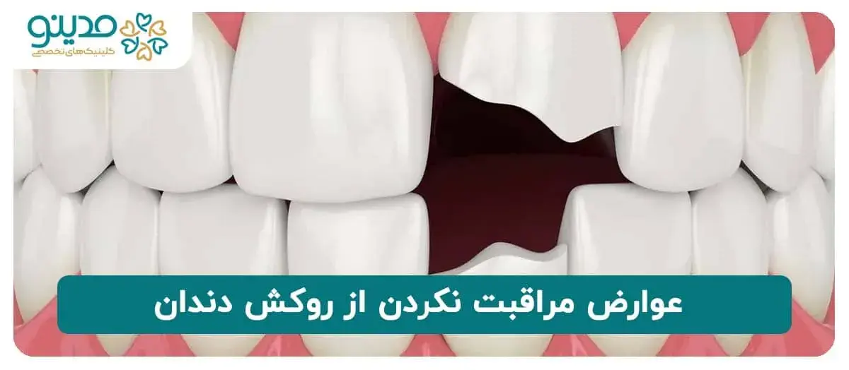 عوارض مراقبت نکردن از روکش دندان