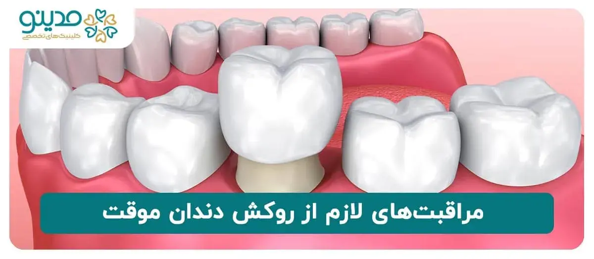 مراقبت‌های لازم از روکش دندان موقت