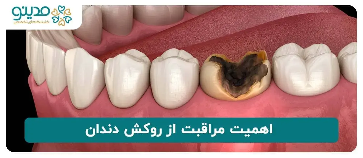 اهمیت مراقبت از روکش دندان