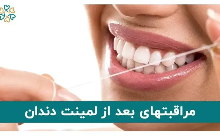  مراقبتهای بعد از لمینت دندان چگونه است و بعد از لمینت چه بخوریم؟ + رژیم غذایی