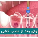 مراقبتهای بعد از عصب کشی دندان