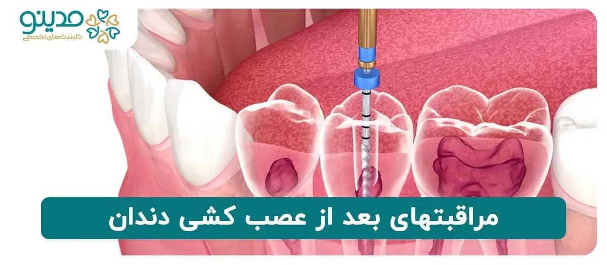 مراقبتهای بعد از عصب کشی دندان