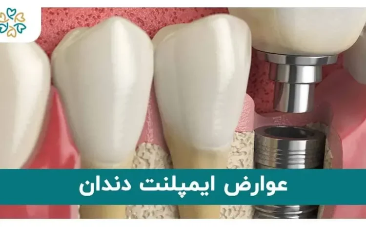  عوارض و خطرات کاشت ایمپلنت دندان؛ آیا ایمپلنت باعث سرطان میشود؟