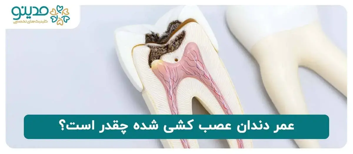 عمر دندان عصب کشی شده چقدر است؟