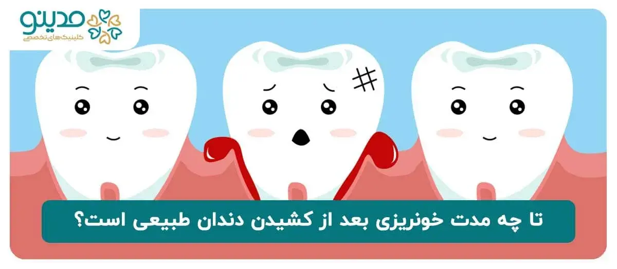 تا چه مدت خونریزی بعد از کشیدن دندان طبیعی است؟