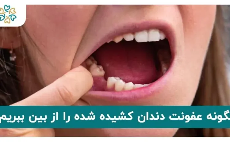  چگونه عفونت دندان کشیده شده را از بین ببریم؟ | درمان خانگی و قرص + عکس