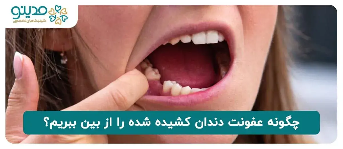 چگونه عفونت دندان کشیده شده را از بین ببریم؟