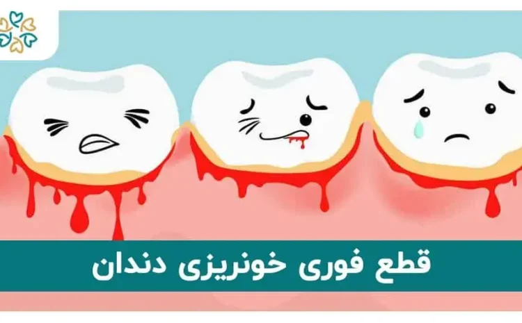  ۶ روش قطع خونریزی دندان کشیده؛ دلیل بند نیامدن خون بعد از کشیدن چیست؟