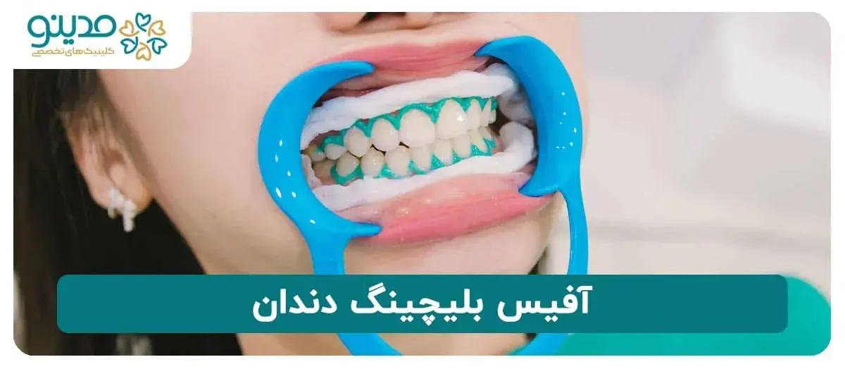 آفیس بلیچینگ دندان