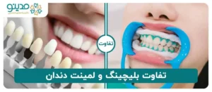 تفاوت بلیچینگ و لمینت دندان