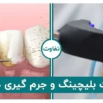 تفاوت بلیچینگ و جرم گیری دندان