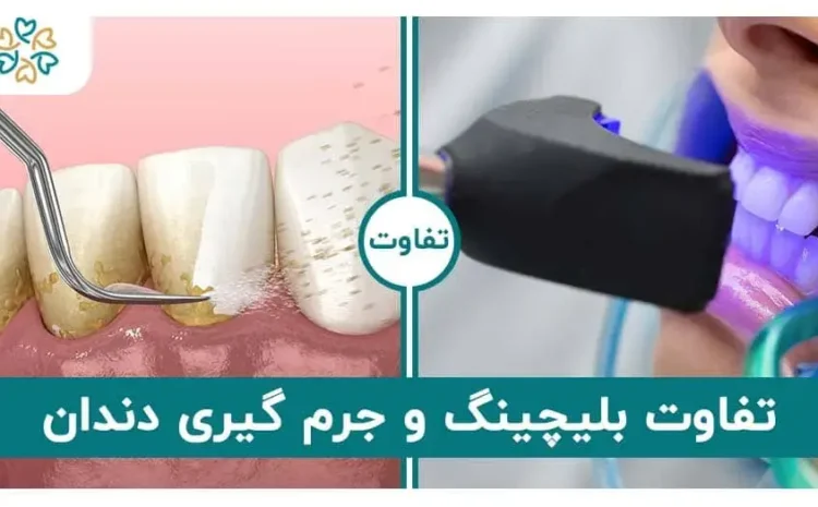  فرق بلیچینگ با جرم گیری؛ بلیچینگ بهتر است یا جرم گیری؟