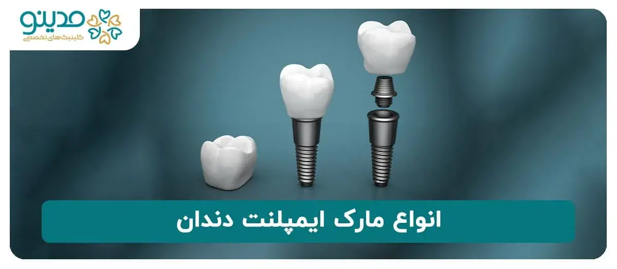 انواع مارک ایمپلنت دندان