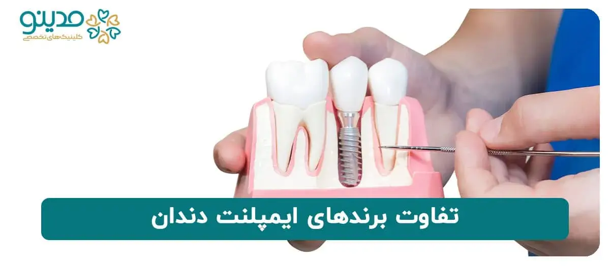 تفاوت برندهای ایمپلنت دندان در چیست؟