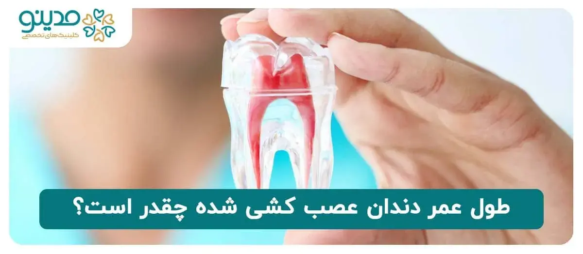 طول عمر دندان عصب کشی شده چقدر است؟