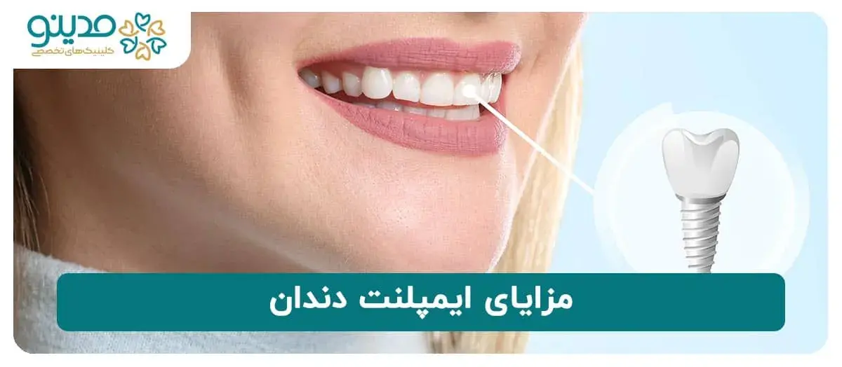 مزایای ایمپلنت دندان 