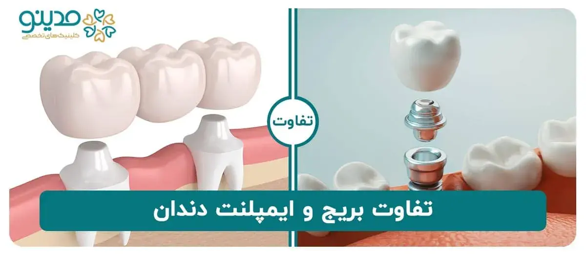 تفاوت بریج و ایمپلنت دندان