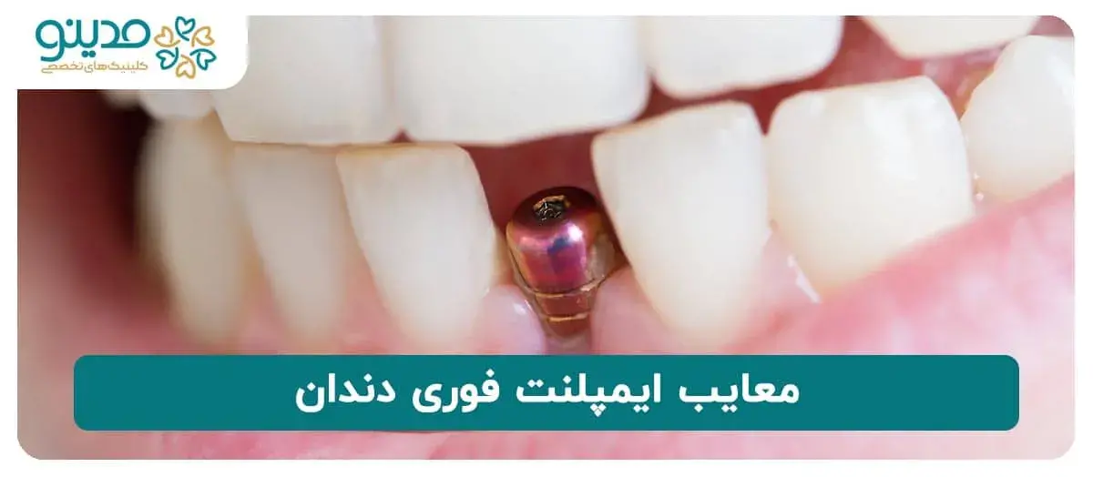 معایب ایمپلنت فوری دندان