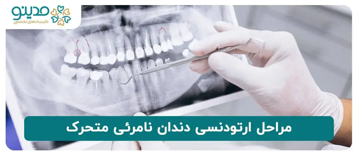 مراحل ارتودنسی دندان نامرئی متحرک