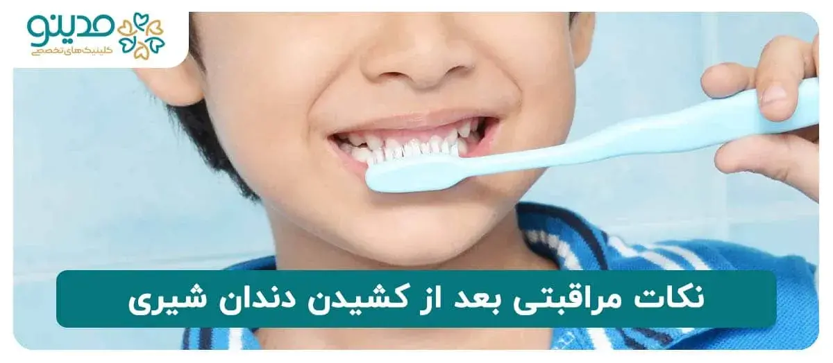  نکات مراقبتی بعد از کشیدن دندان شیری 