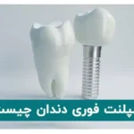 ایمپلنت فوری دندان چیست؟