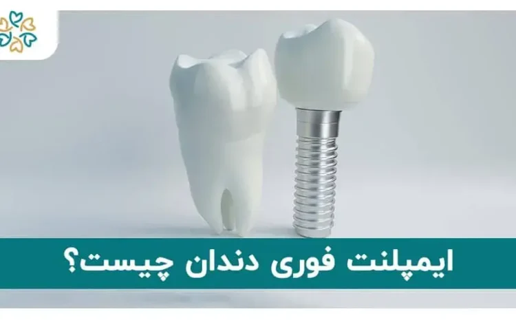  ایمپلنت فوری دندان چیست؟ | بهترین دکتر ایمپلنت فوری در تهران