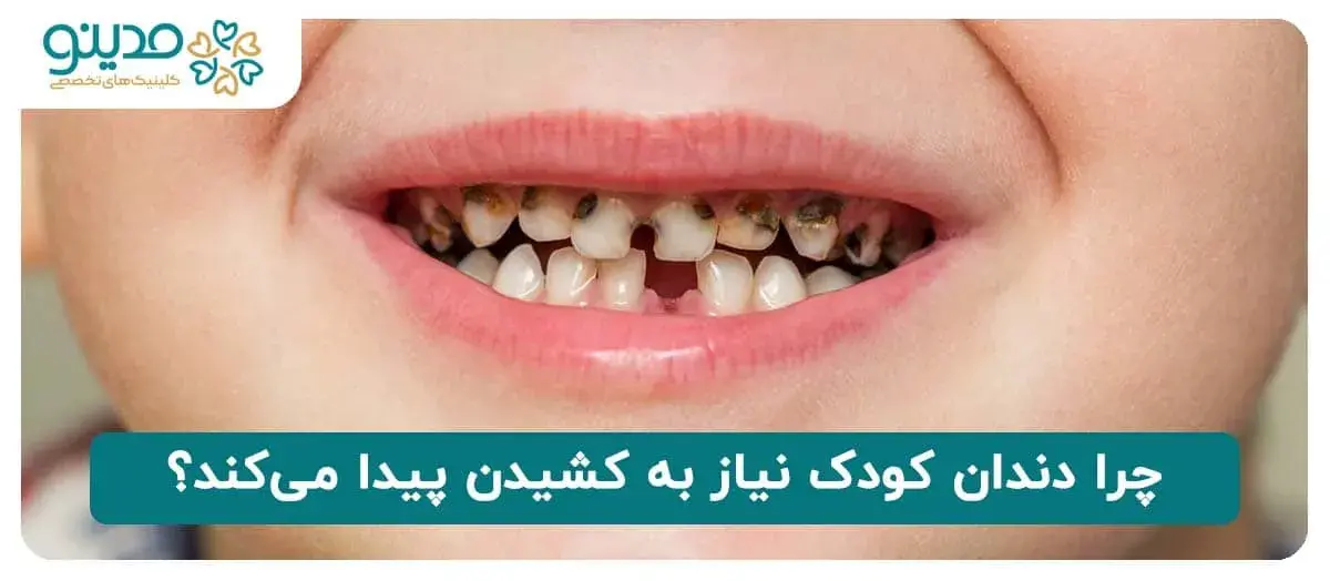 چرا دندان کودک نیاز به کشیدن پیدا می‌کند؟