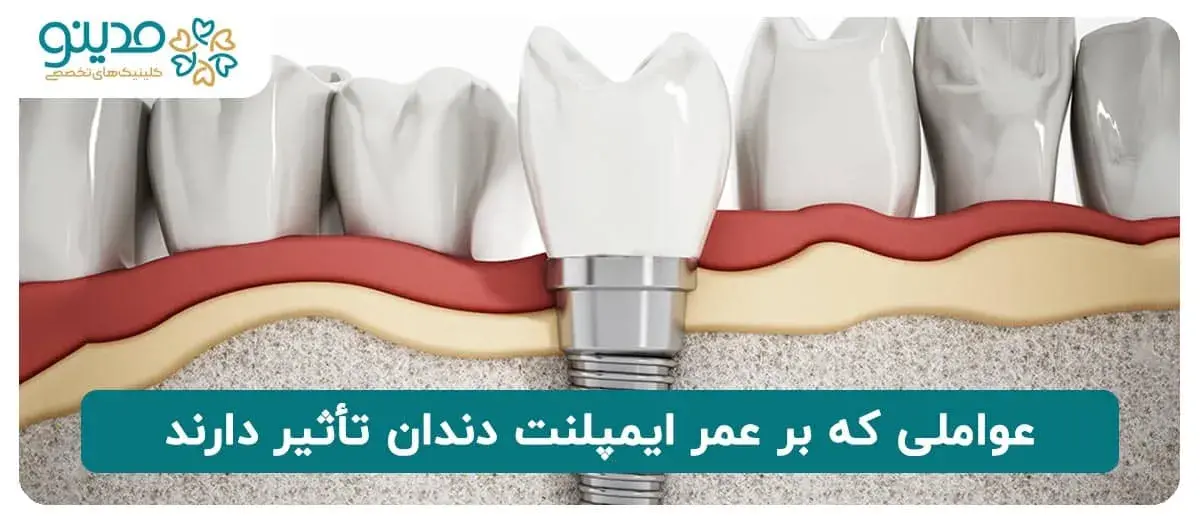 عواملی که بر عمر ایمپلنت دندان تأثیر دارند