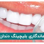 ماندگاری بلیچینگ دندان