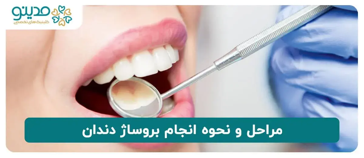 مراحل و نحوه انجام بروساژ دندان
