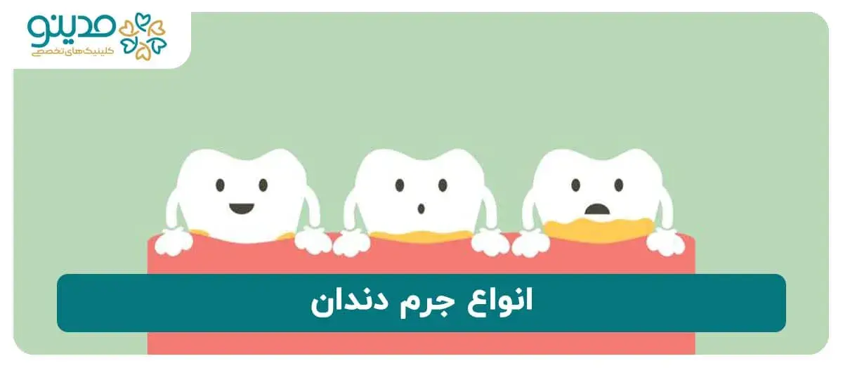 انواع جرم دندان 