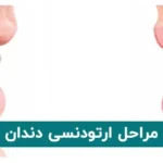 مراحل ارتودنسی دندان