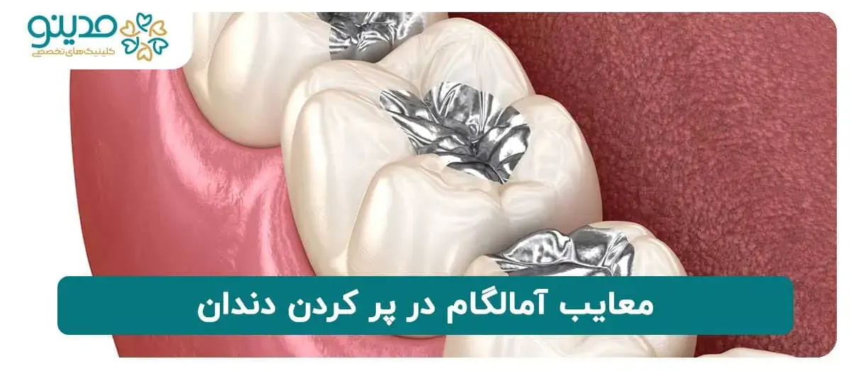 معایب آمالگام در پر کردن دندان