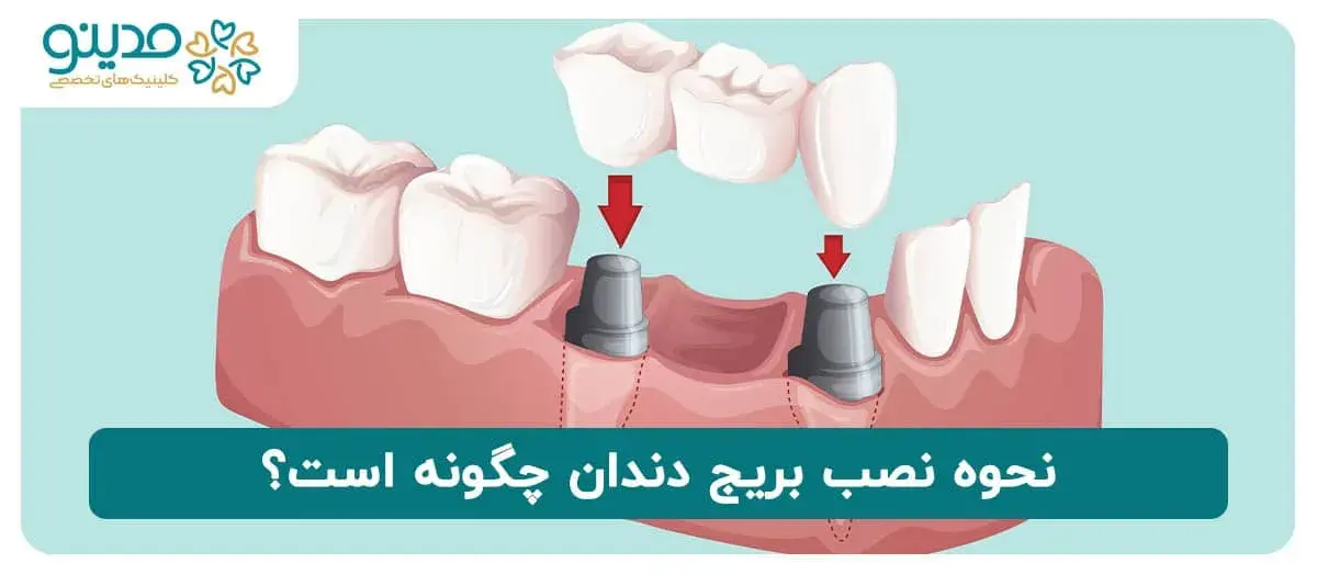 نحوه نصب بریج دندان