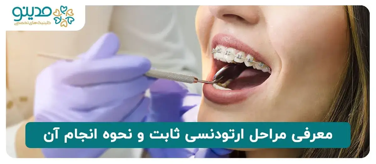 معرفی مراحل ارتودنسی ثابت و نحوه انجام آن