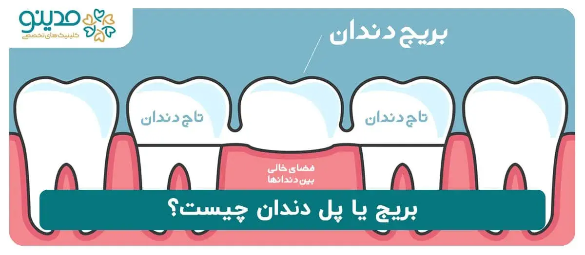 بریج یا پل دندان چیست؟